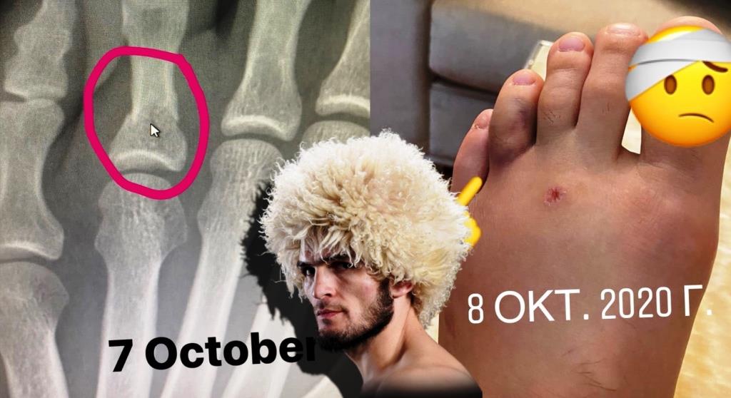 Khabib Nurmagomedov showed a fracture received before the fight with Gaethje