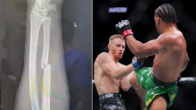 The manager showed an X-ray of Jack Della Maddalena’s broken forearm after the fight at UFC 299